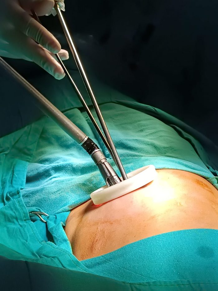 Cirujanos del Notti extirparon con técnicas novedosas un quiste pulmonar a un niño de 6